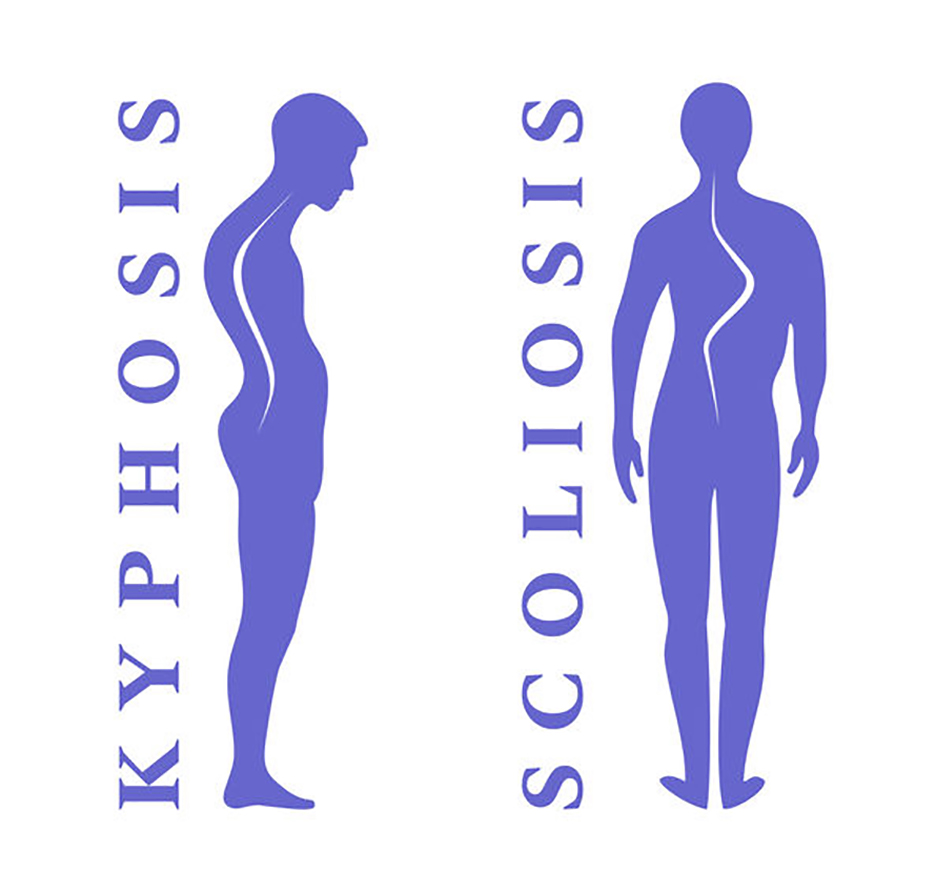 Scoliosis & Kyphosis