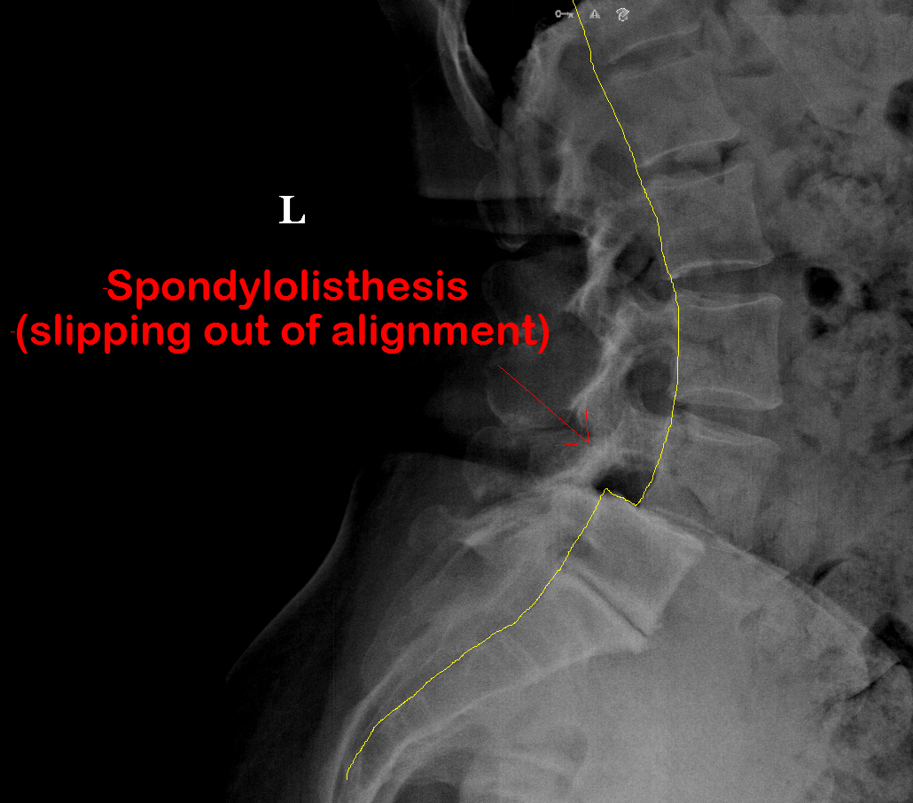 Degenerative Spondylolisthesis