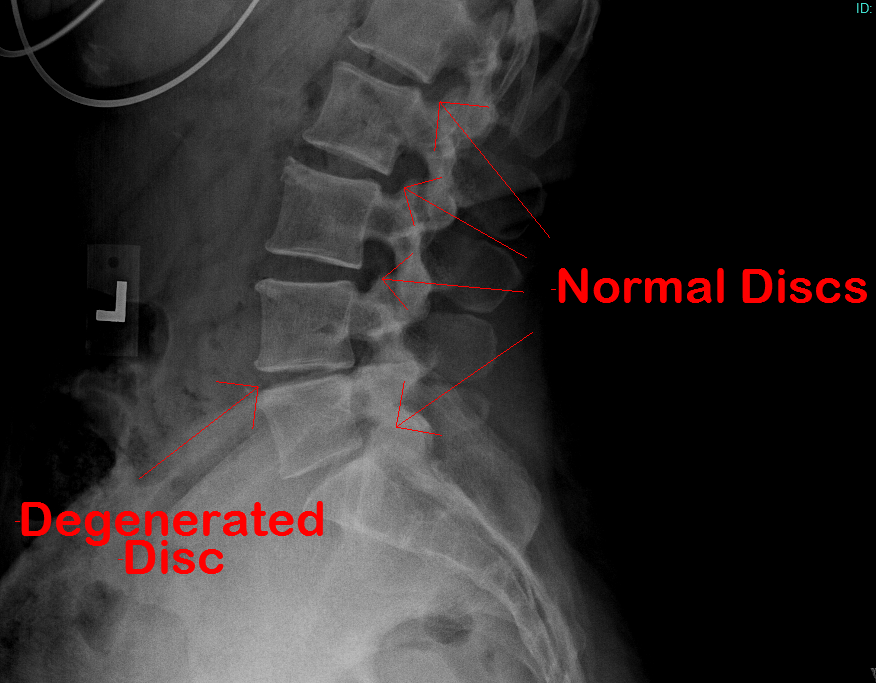 Degenerative Disc Disease