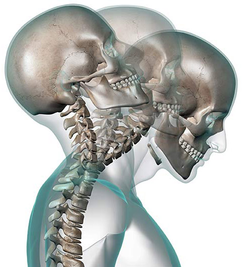 Cervical Strain