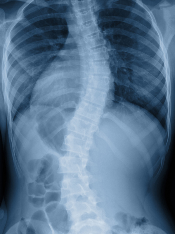 Scoliosis