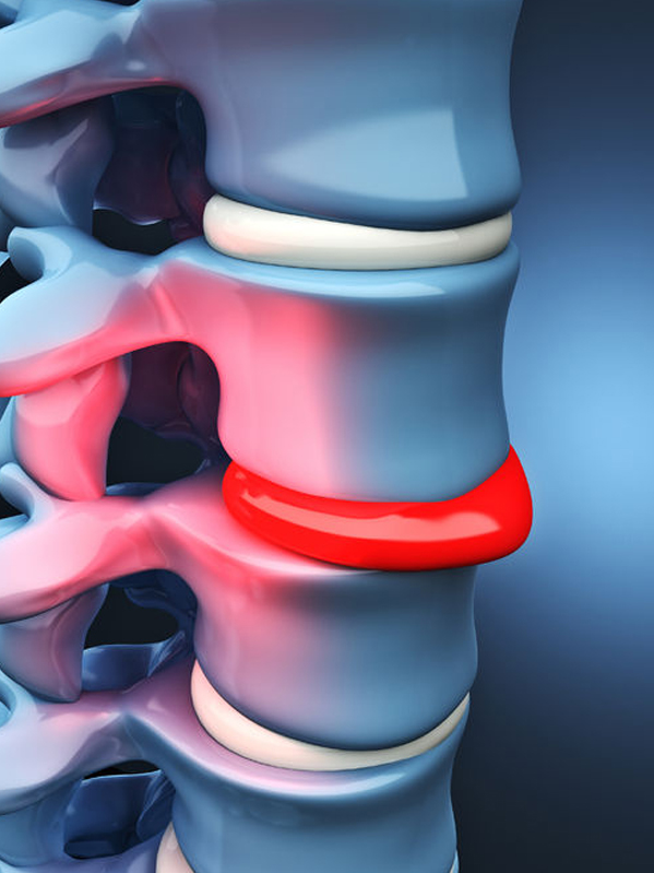 Herniated Disc