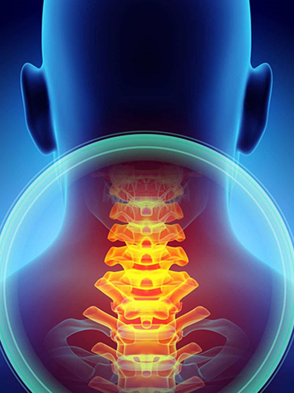 Cervical Stenosis & Myelopathy