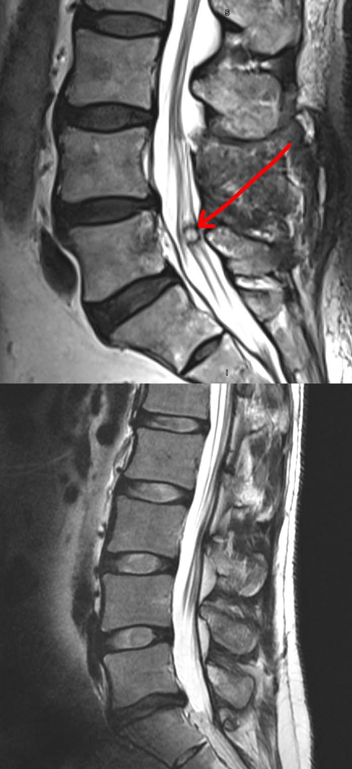 Synovial Cyst of the Spine