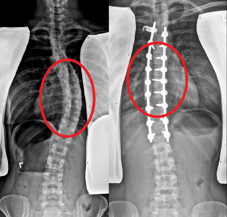 Learn more about Scoliosis.