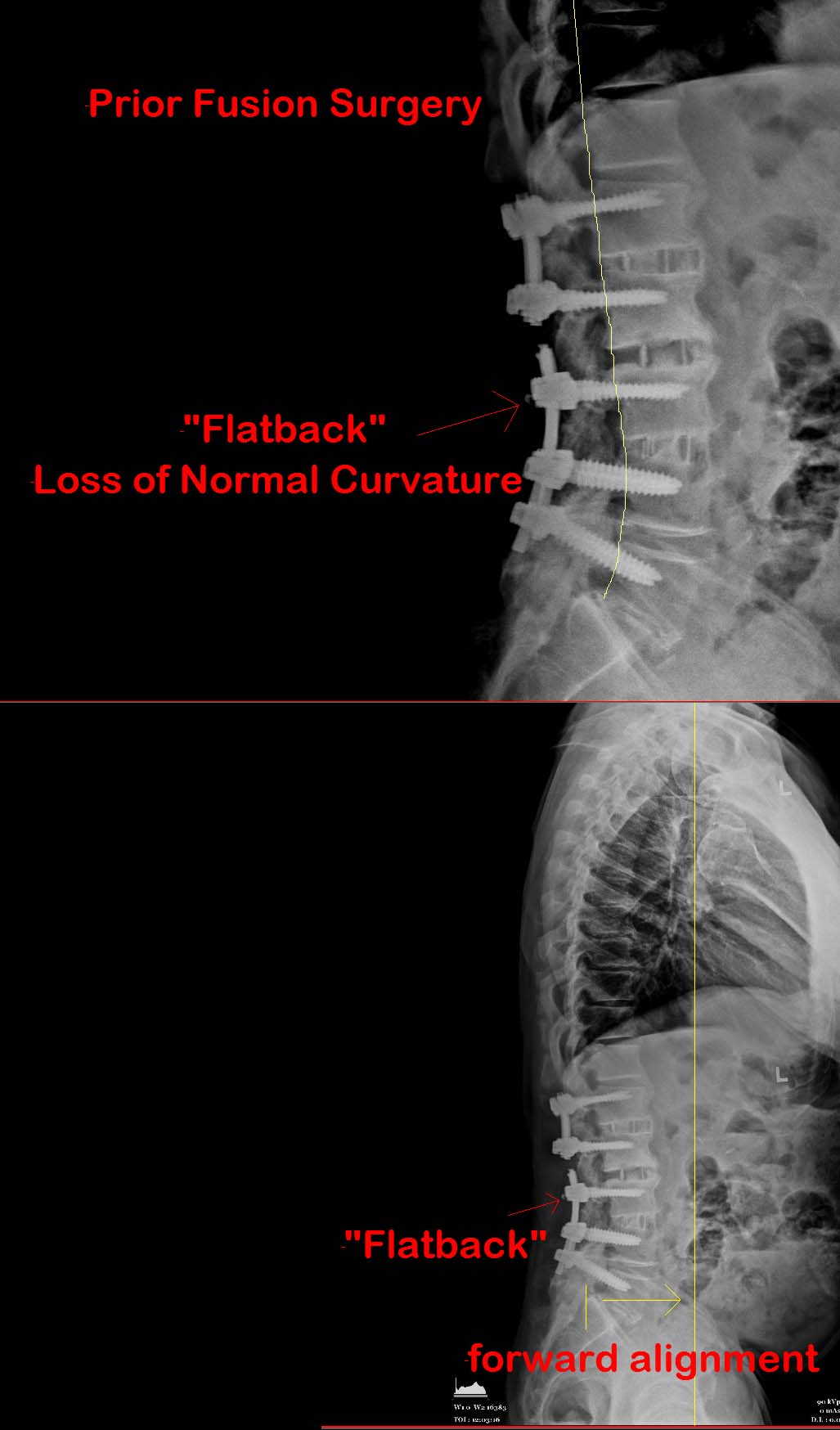 Flatback Syndrome