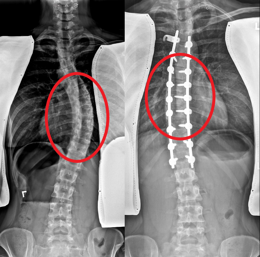 Who Suffers from Spinal Deformities?