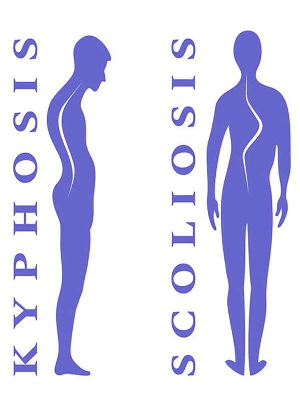 Kyphosis