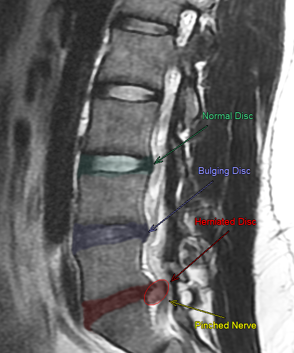 Minimally Invasive Microdiscectomy