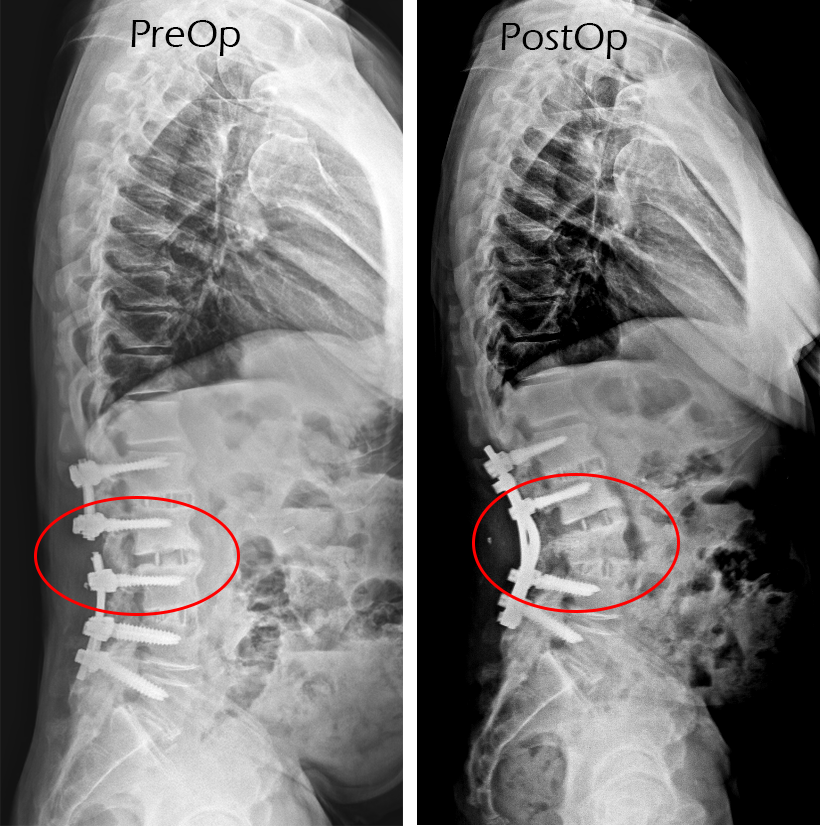 Spinal Fusion Revision