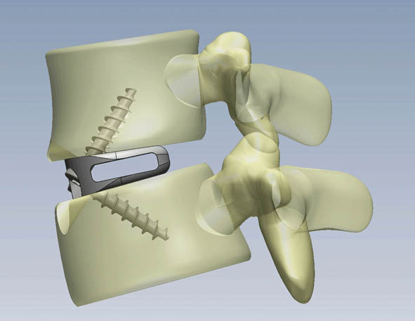 Anterior Lumbar Interbody Fusion