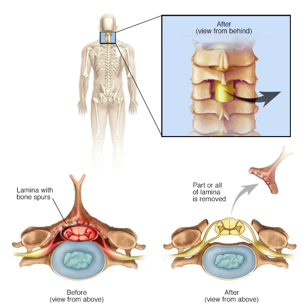 Benefits of a Cervical Laminectomy