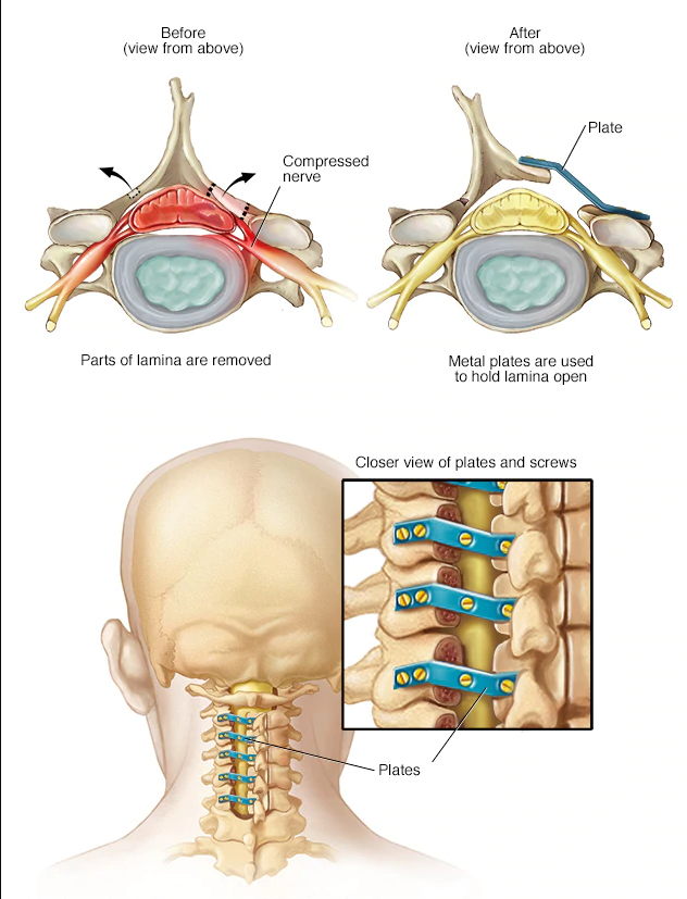 The Laminoplasty Procedure