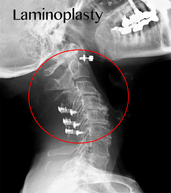Cervical Laminoplasty