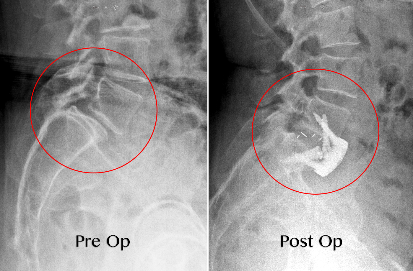 Oblique Lumbar Interbody Fusion (OLIF)