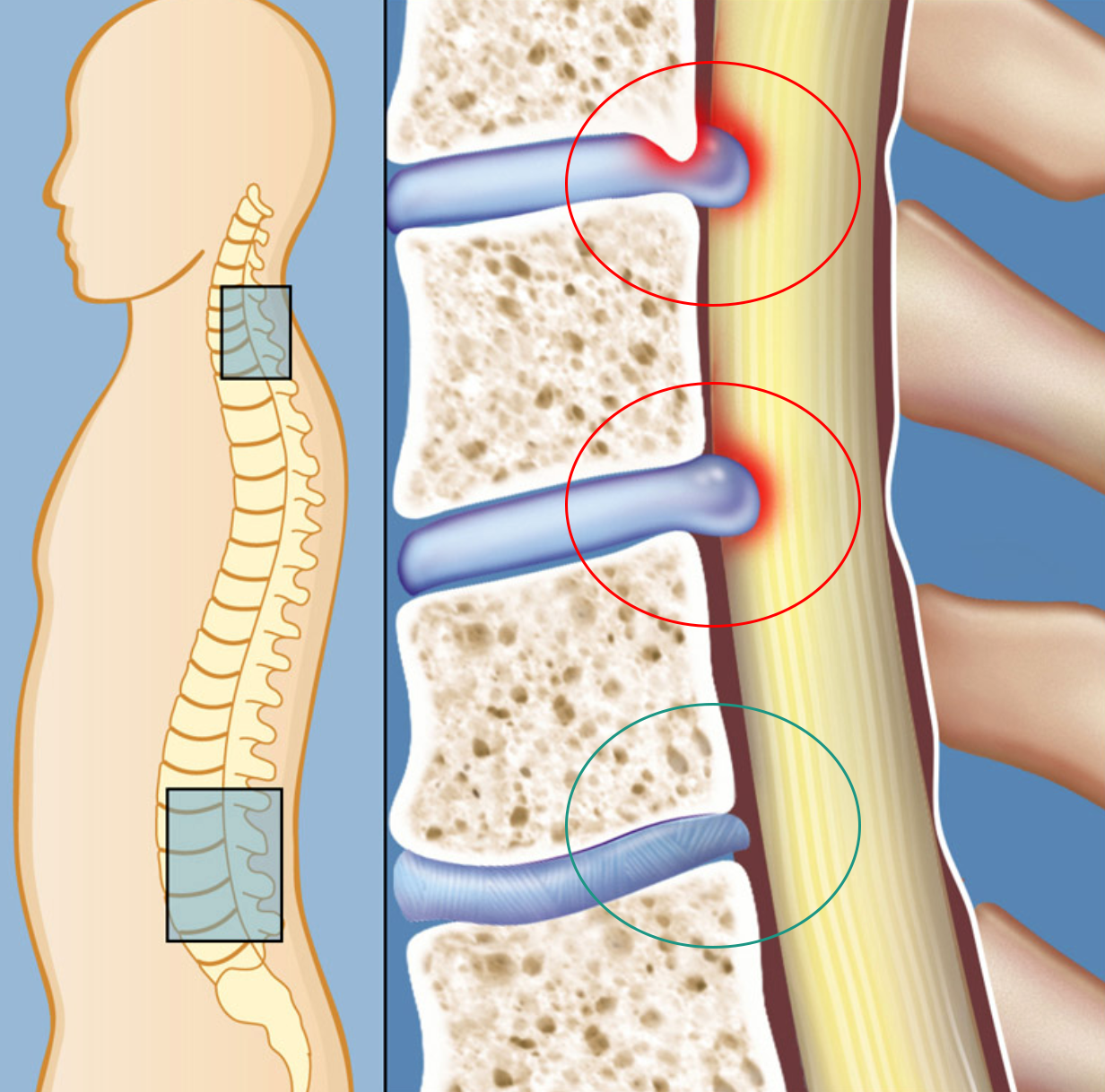 Minimally Invasive Microdecompression