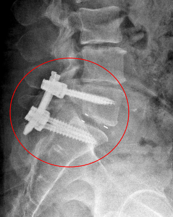 Minimally Invasive Transforaminal Lumbar Interbody Fusion (MIS – TLIF)