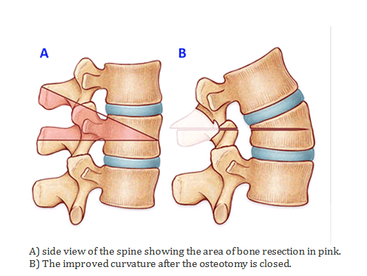 Spinal Osteotomy