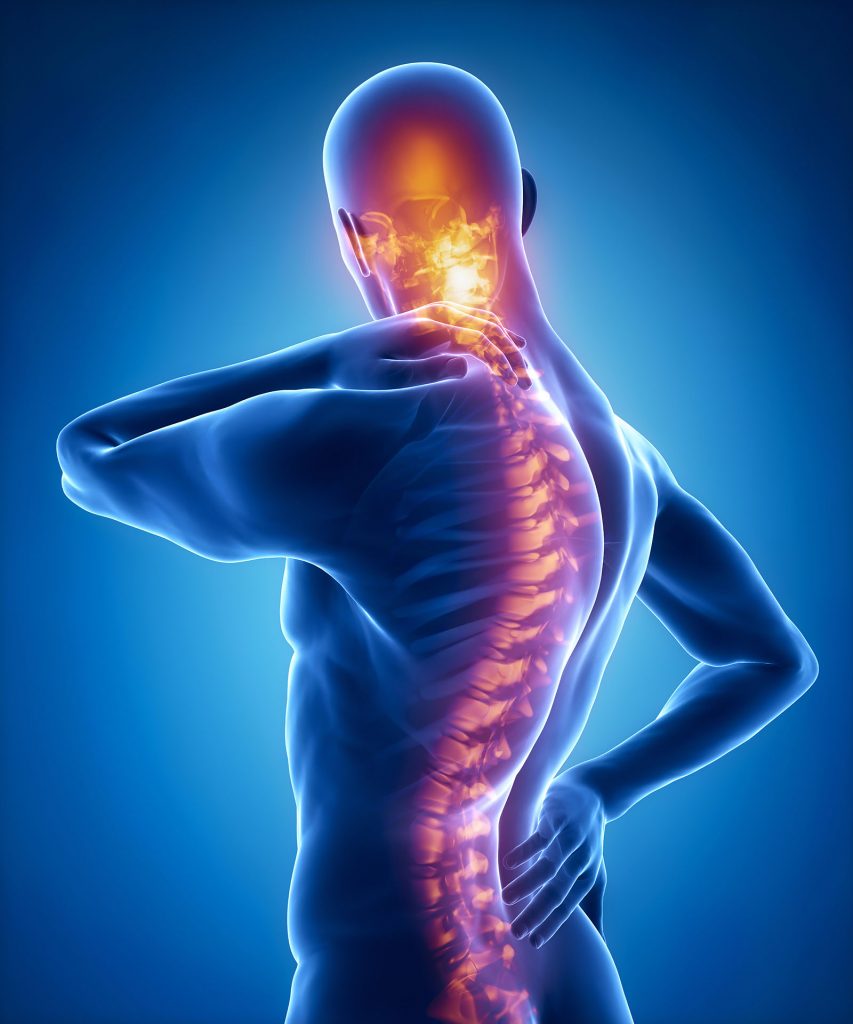 Scheuermann's Kyphosis, abnormal curvature of the upper spine, can be treated with a Spinal Osteotomy procedure.