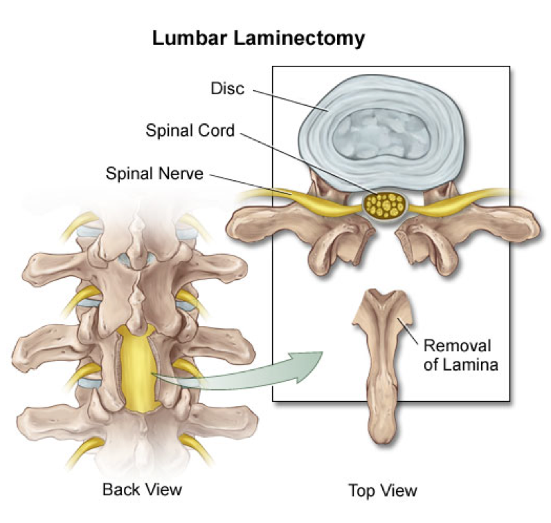 The illustration above shows the removal of the Lamina, and how it is able to relieve the compression of the spinal cord and nerves.