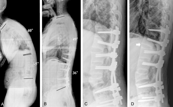 Spinal Osteotomy Procedure