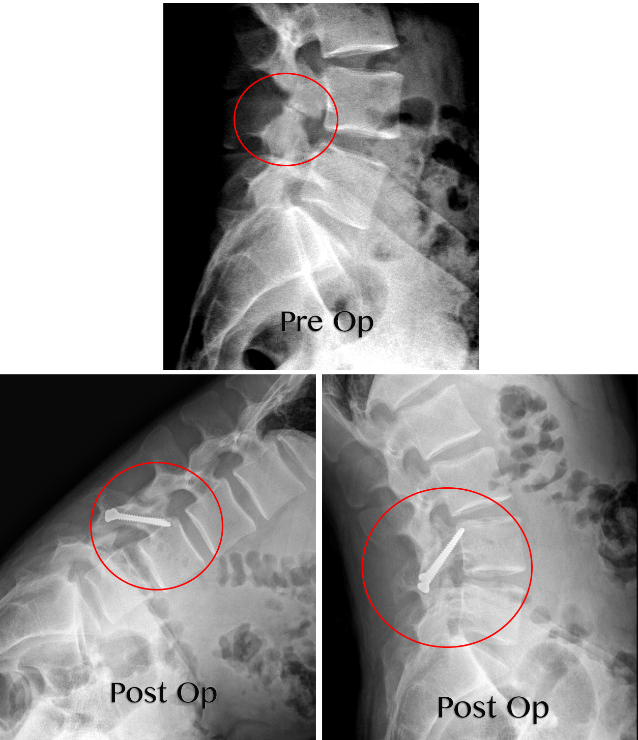 Motion Preservation Surgery