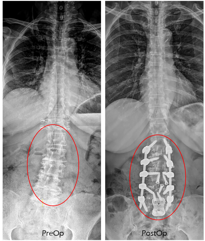 Spondylolisthesis