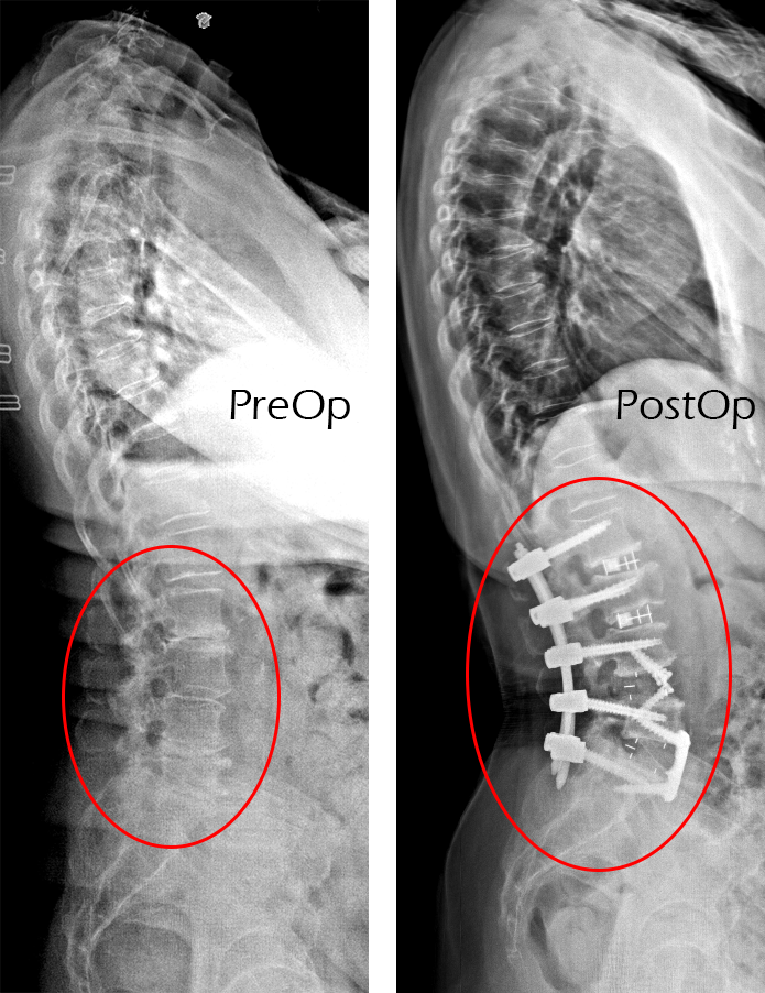 Causes of Such Spinal Deformities