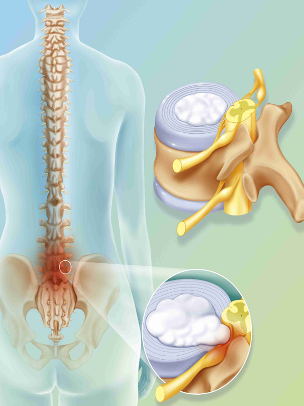What Does Revision Spine Surgery Entail?