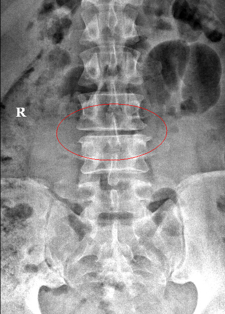 Extreme Lateral Interbody Fusion (XLIF)
