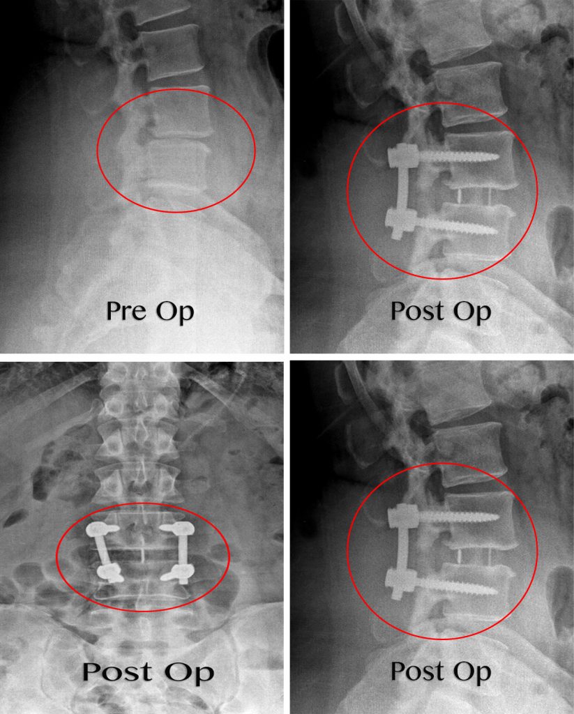 4xray Pre Porst Manhattan Spine Consultants 