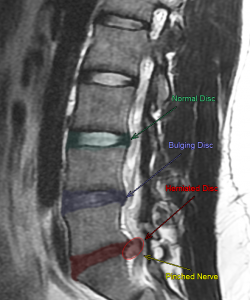 MIS MD – HERNIATED DISC | Manhattan Spine Consultants