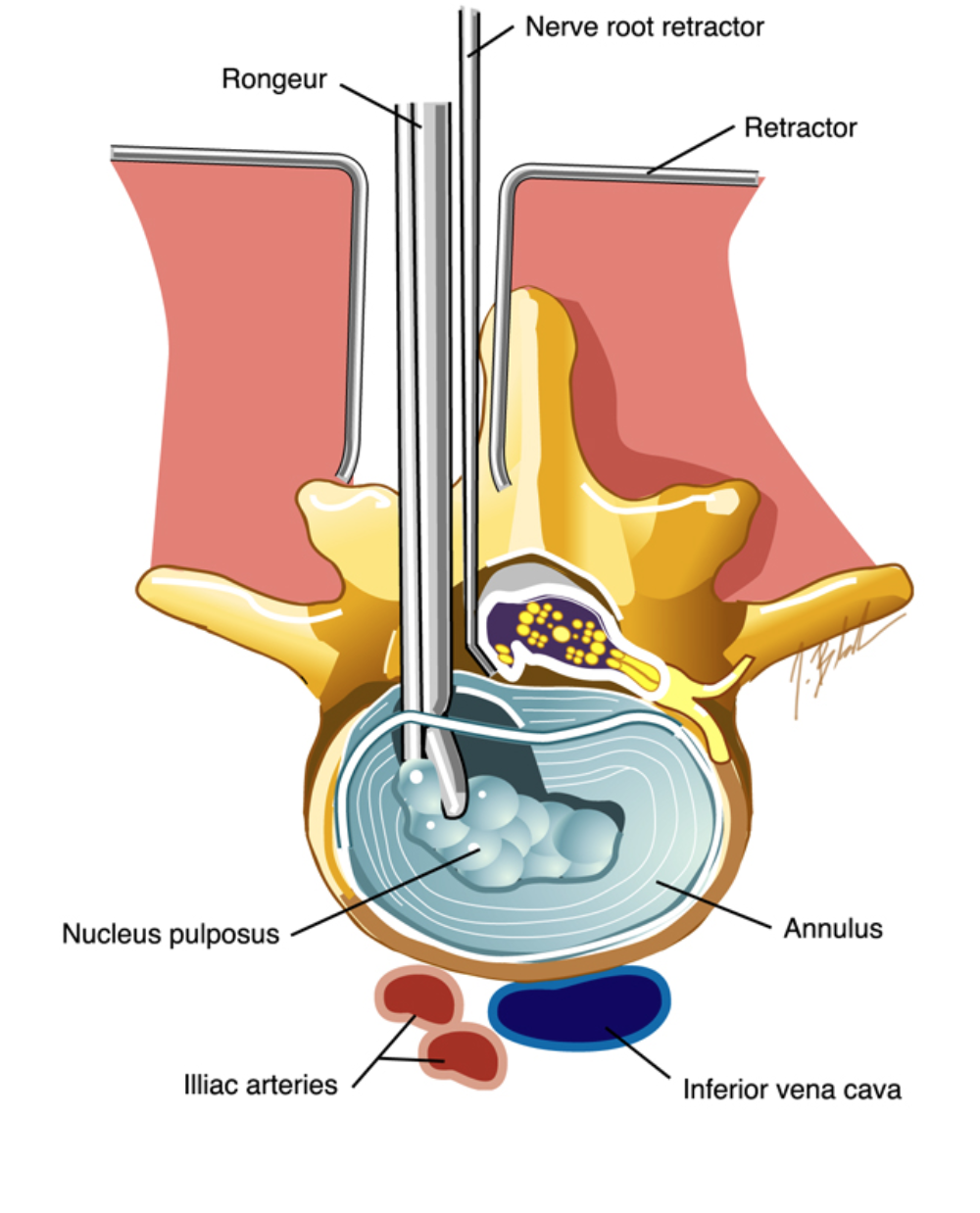 What is the code for a lumbar Microdiscectomy?