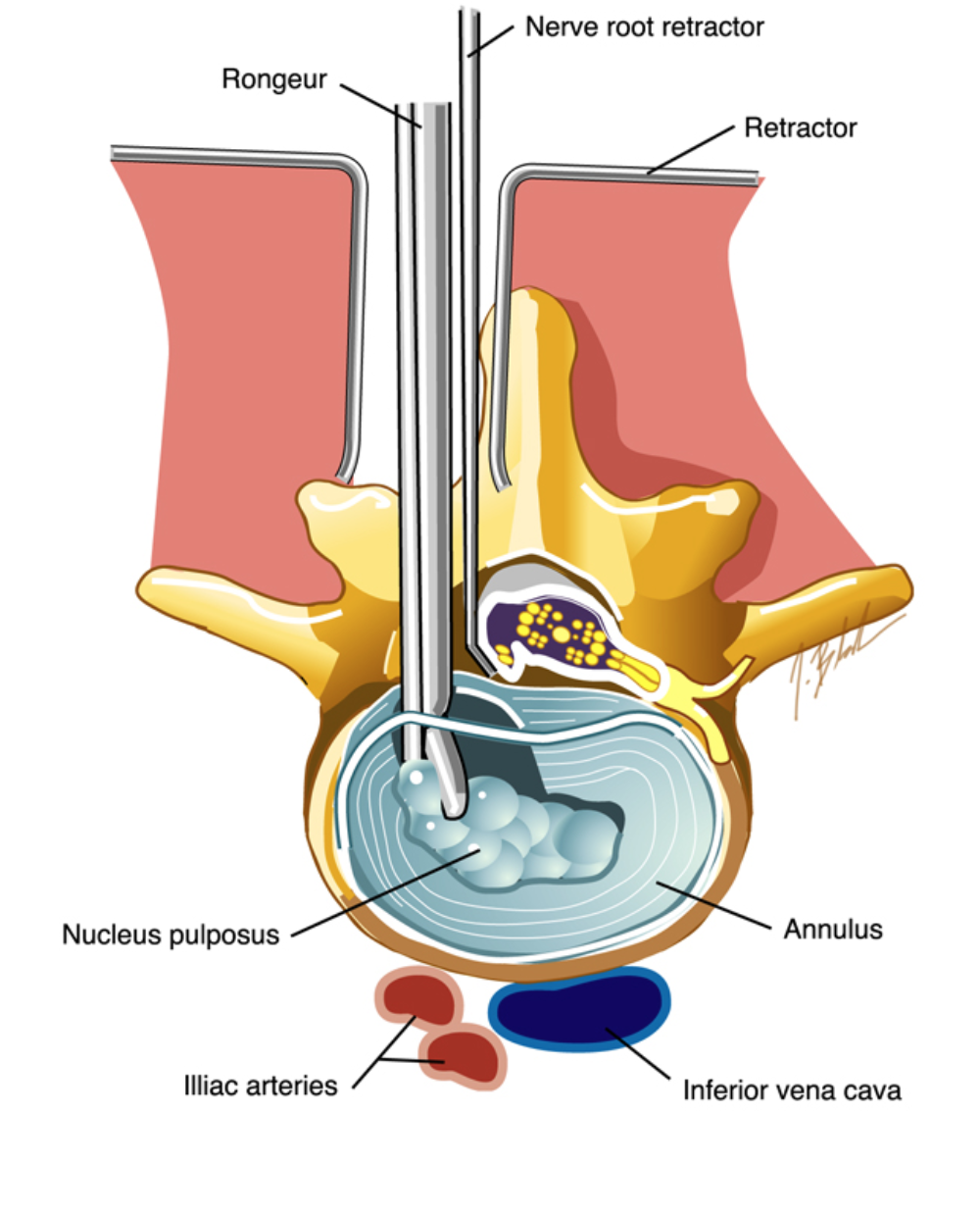 minimally-invasive-microdiscectomy-manhattan-spine-consultants