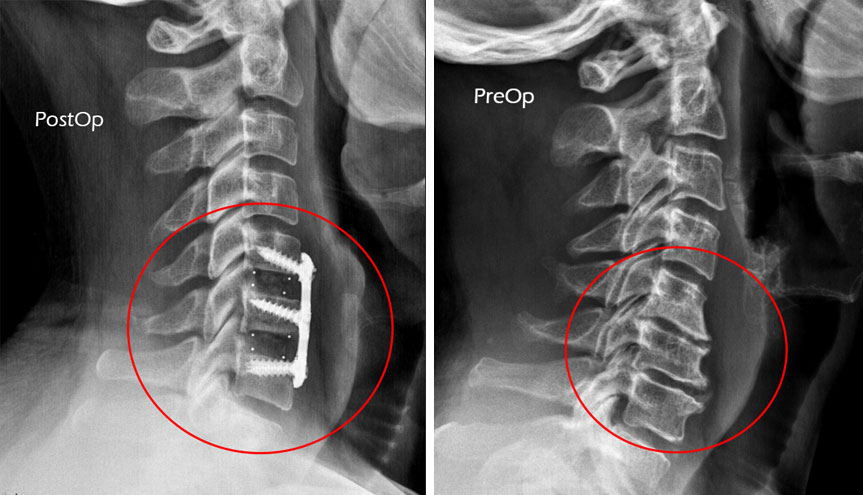 Anterior Cervical Discectomy And Fusion Acdf Manhattan Spine