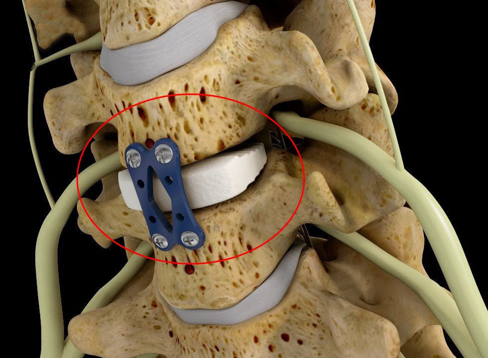 Whats Involved In Anterior Cervical Discectomy And Fusion Spine ...
