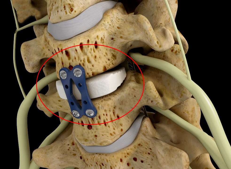 Whats Involved In Anterior Cervical Discectomy And Fusion Spine   VARMA ACDF Animation 