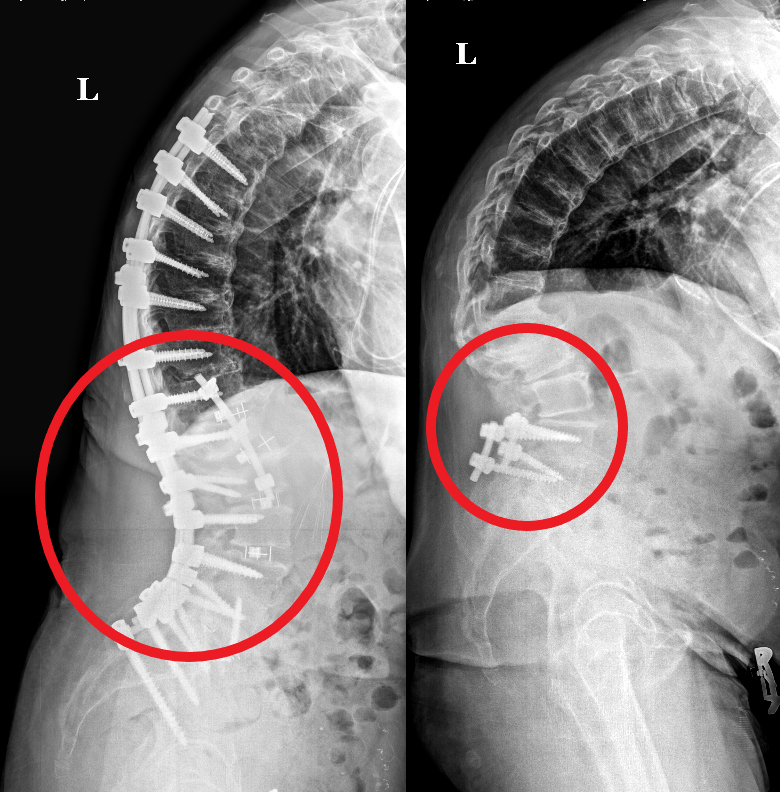 what-is-lumbar-spinal-instability-know-its-causes-treatment