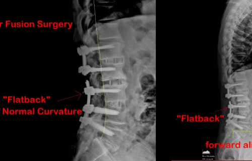 Flatback Syndrome