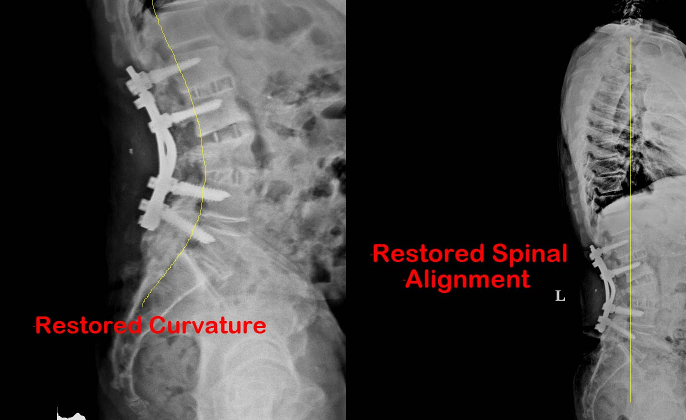 Causes of Flatback Syndrome